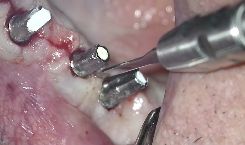 The Advanced Training Workshop on Soft Tissue Management and Treatment of Peri-implantitis is an interactive course aiming at clinicians wishing to upgrade their skills in the soft tissue management around implants to treat mucogingival deficiencies and in the application of non-surgical and surgical treatment to peri-implant diseases. The course consists of an integrated approach designed to build and extend the competence of the practicing periodontist in the area of contemporary mucogingival surgery, peri-implant surgery, microsurgery and minimally invasive surgery. The topics will be covered with lectures powered by 2D and 3D video demonstrations, case discussions, and focused hands-on training on animal and silicon models.