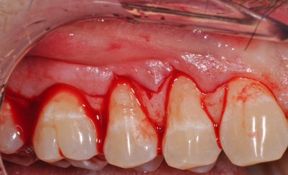 The Advanced Training Workshop on Mucogingival surgery is an interactive course aiming at clinicians wishing to upgrade their skills in the soft tissue management around teeth. This Advanced course is specifically designed to discuss in details the treatment of mucogingival deficiencies and gingival recessions in single and multiple sites. The world renown expert on mucogingival surgery, Dr Cortellini, and his team, will explain and discuss periodontal plastic surgery with lectures, 2D and 3D video demonstrations, focused hands-on training on animal models, and case discussion. Indications and contraindications of soft tissue augmentation around teeth, the use of biomaterials and the most advanced mucogingival surgery approaches will be thoroughly presented and discussed.