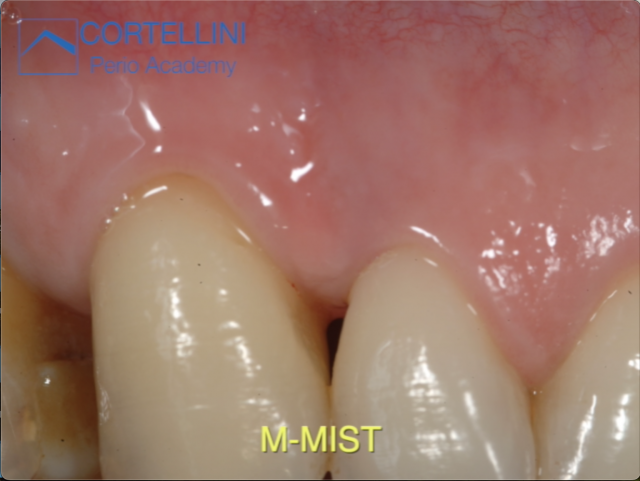 Periodontal Regeneration Cases: M-MIST techinque