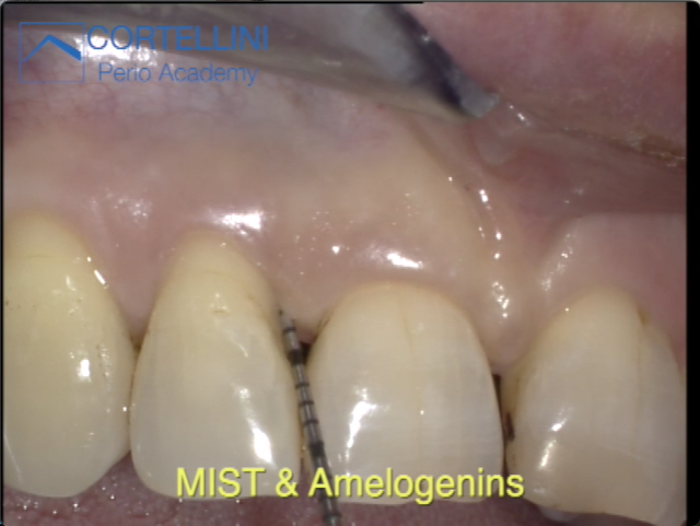 Periodontal Regeneration Cases: MIST tecnique & Amelogenins