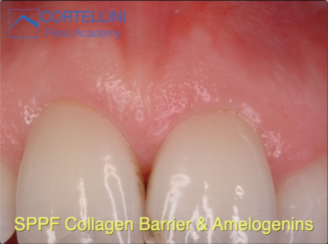 Periodontal Regeneration Cases: SPPF Collagen Barrier & Amelogenins