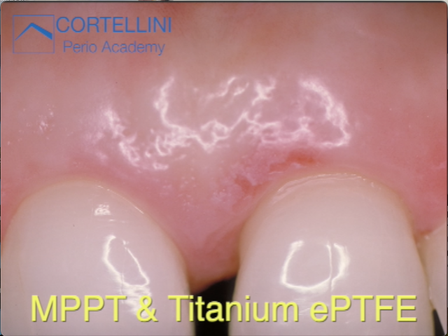 Periodontal Regeneration Cases: MPPT & Titanium ePTFE