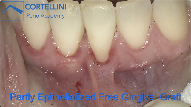 The Partially Epithelialized Free Gingival Graft (PE-FGG)
