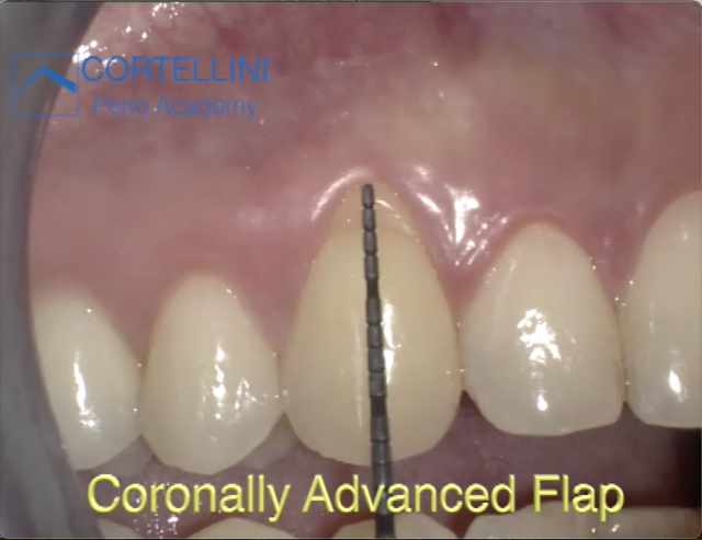The Coronally Advanced Flap