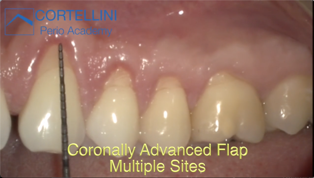 The Coronally Advanced Flap (CAF) on multiple sites with one vertical releasing incision