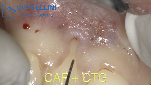 The Coronally Advanced Flap with CTG